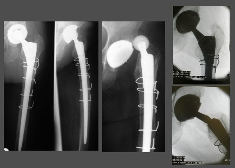 Abb. 6: Das Beispiel zeigt wie eine Luxationsneigung durch isolierten Austausch...