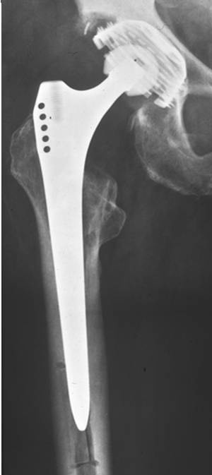 Abb. 1 a, b: Monoblock-Revisionsschäfte erfordern in der Regel eine distale...