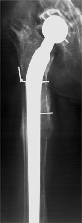 Abb. 1 a, b: Monoblock-Revisionsschäfte erfordern in der Regel eine distale...