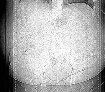 Case 1, Bild 1: Untersuchung zur Planung einer renalen Denervierung. Kräftiger...