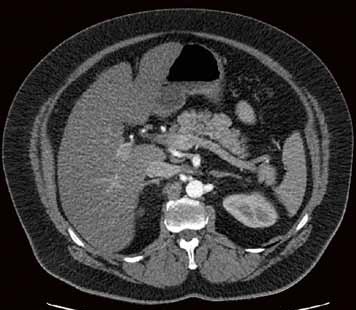 Case 1, Bild 2: Untersuchung zur Planung einer renalen Denervierung. Sehr gute...