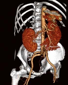 Case 1, Bild 3: Untersuchung zur Planung einer renalen Denervierung.Trotz...