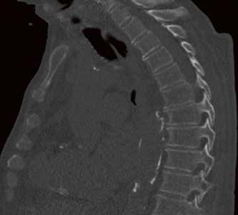 Case 2, Bild 1: Patientin nach einem Polytrauma mit einer Lungenlazeration....