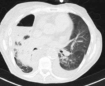 Da Case 2, Bild 2: Patientin nach einem Polytrauma mit einer Lungenlazeration....