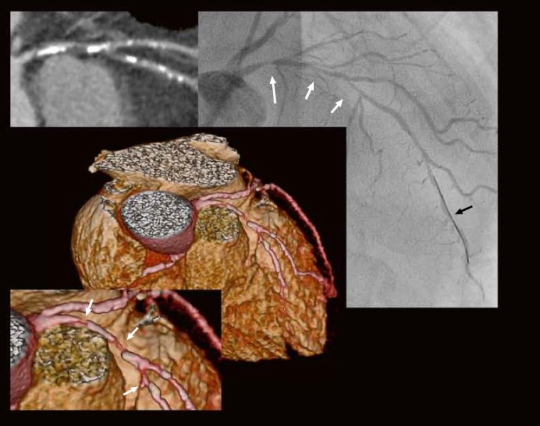 Fall 3: 76-jähriger Mann, in letzter Zeit zunehmend retrosternales...