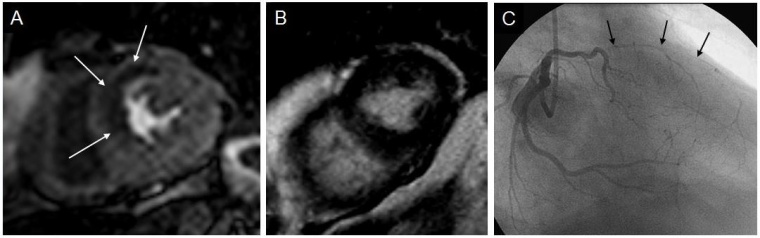 MRT-Adenosin-Perfusions-Untersuchung des Herzens mit Darstellung eines großen...