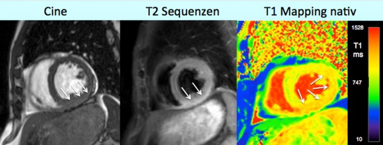Abb. 2: 56-jähriger Patient nach grippalem Infekt, weiteres siehe Haupttext.