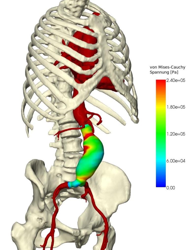 Abb. 1: Dreidimensionale Darstellung eines Aorten-Aneurysmas im Bauchraum. Die...
