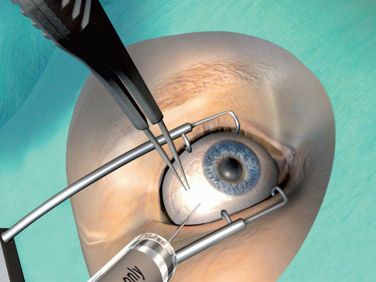 Abb. 1: Intravitreale Injektion