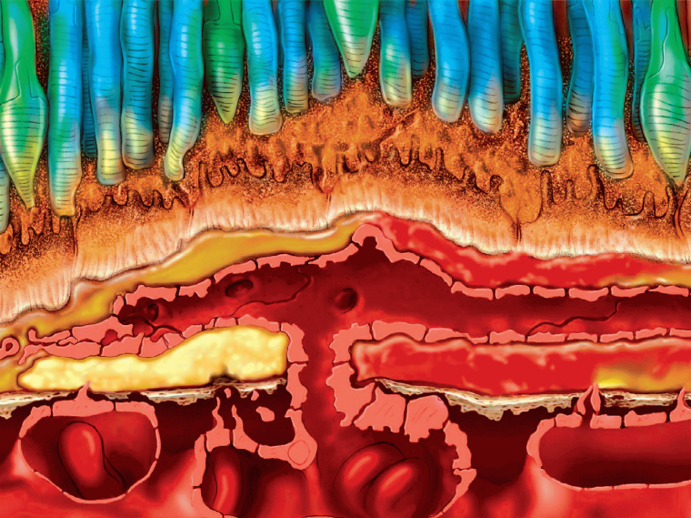 Abb. 2: Feuchte AMD: Einwachsen der Gefäße in die RPE.