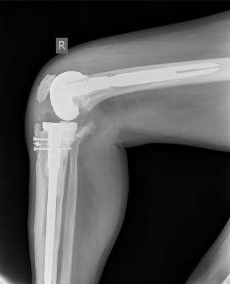 Rezidive der tiefen Patellae kommen trotz korrekter Wiederherstellung der...