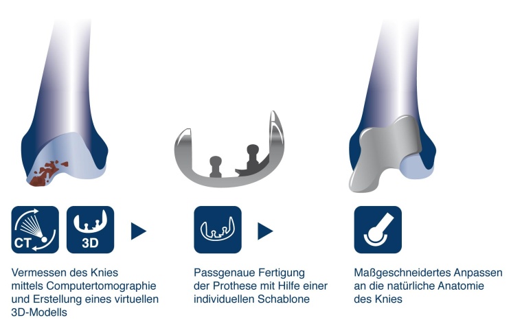 Abb. 1: Herstellungsverfahren für ein individuelles Knieimplantat