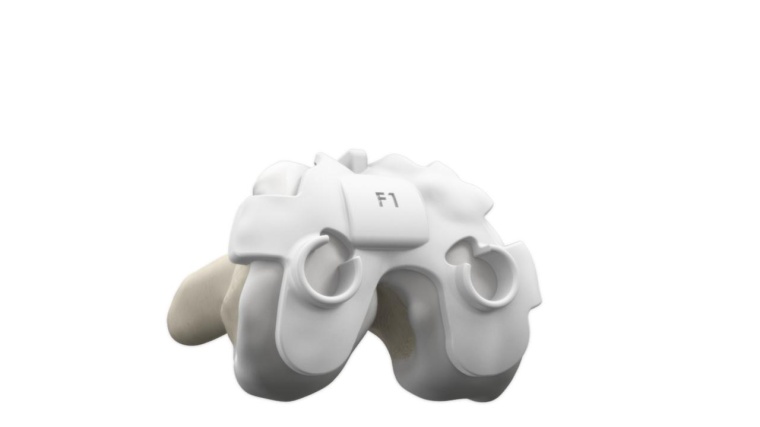 Abb. 3: Individuelle Totalendoprothese