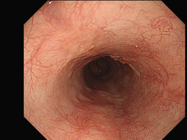 Darstellung der Speiseröhre im Weißlicht (Foto: Olympus Deutschland).