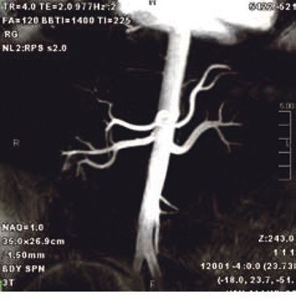 Kontrastmittellose MR-Angiografie der Nierengefäße mit dem time-SLIP-Verfahren