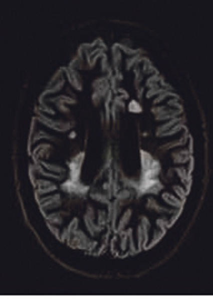 3D-Double-Inversion-Recovery-Sequenz zur zuverlässigen Unterdrückung sowohl...