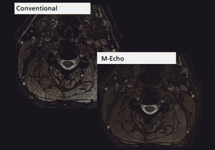 mEcho-Verfahren im Vergleich zur konventionellen T2*-Bildgebung in der HWS