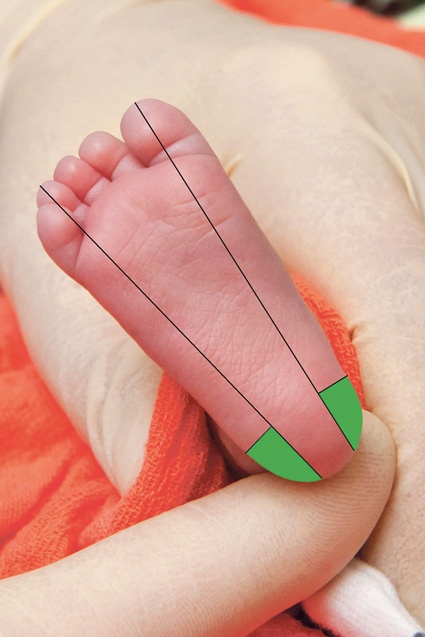 Abb. 1: Kapilläre Blutentnahme für Neugeborenen Screening durch Punktion der...