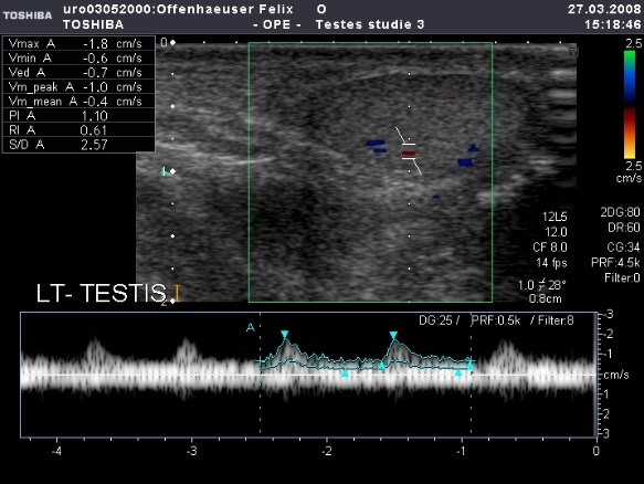 Intratestikuläre Blutflusskurve beim Säuglingshoden.