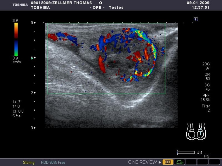 Granulosazelltumor; zystische, hyperperfundierte Raumforderung im linken Hoden.