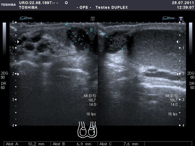 Hydatidentorsion; torquierte, inhomogene Hydatide am Hodenoberpol.