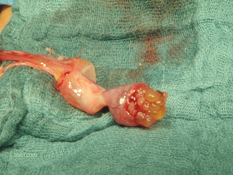 Granulosazelltumur; intraoperativer Befund des unklaren zystischen...