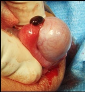 Hydatidentorsion; intraoperativer Befund einer torquierten Hydatide.