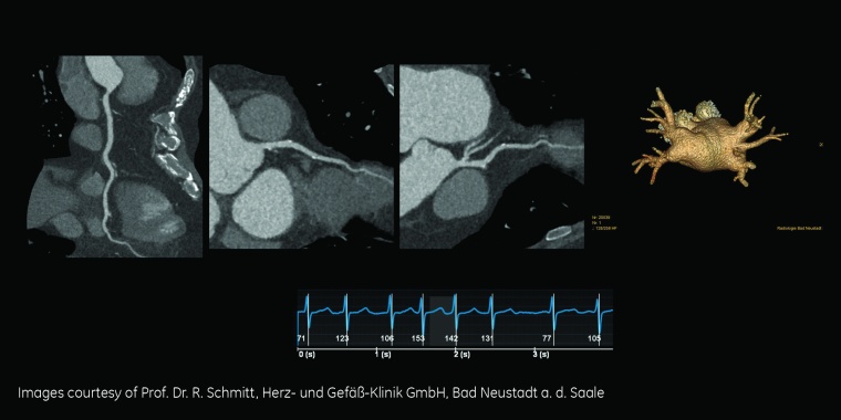 Fallstudie: Low Dose CCTA bei Patienten mit persistierendem Vorhofflimmern,...
