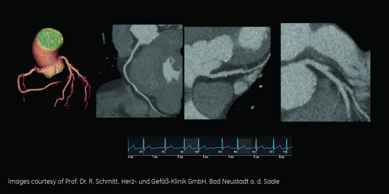 Fallstudie: CCTA bei absoluter Arrhythmie mit Vorhofflimmern, BMI 33...