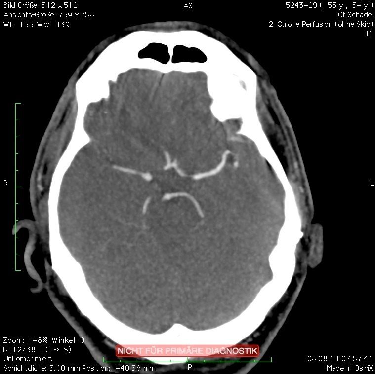 c: Deutliche Reduktion der Aufhärtungsartefakte nach der SEMAR-Rekonstruktion.