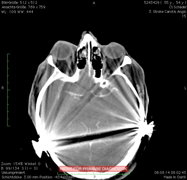 b: Aufhärtungsartefakte erschweren die Lokalisation des Gefäßverschlusses.
