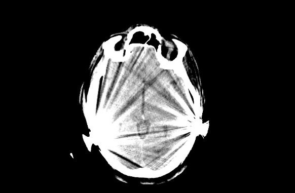 Abb. 2: Verwendung von SEMAR - Apoplex bei beidseitigem Cochlea-Implantat; a:...