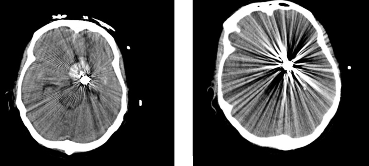 Abb. 1: Verwendung von SEMAR nach Subarachnoidalblutung mit Coiling eines...
