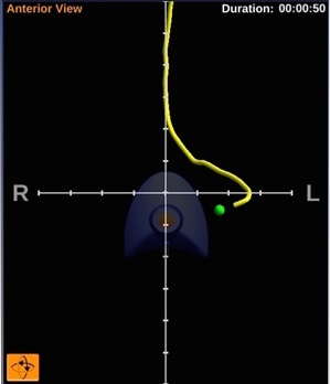Abb. 1: Auf dem Monitorbild ist der Sondenverlauf durch die Speiseröhre in den...