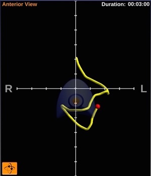 Abb. 1: Auf dem Monitorbild ist der weitere Verlauf im duodenalen C dargestellt.