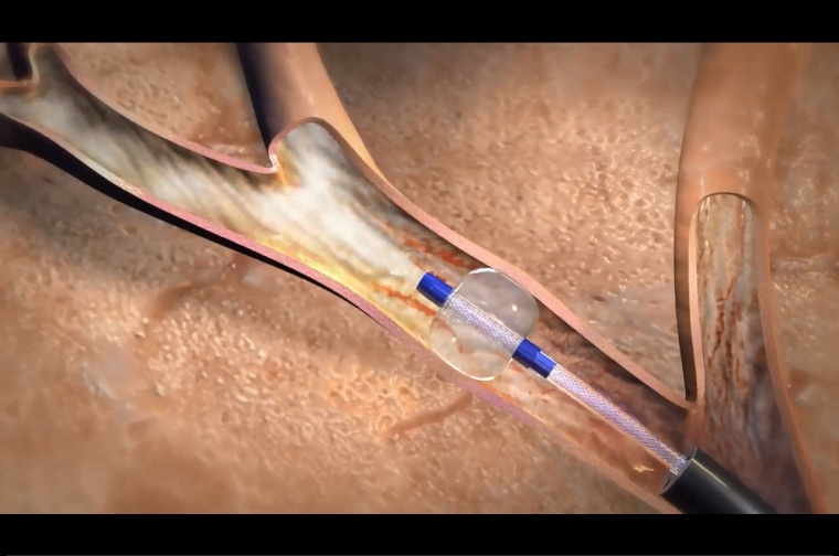 Segmentale Vaporablation.