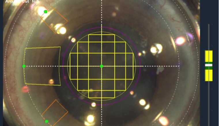 Hornhautschnitte, Kapsulotomie, Lisenfragmentation mit dem Femtosekundenlaser.