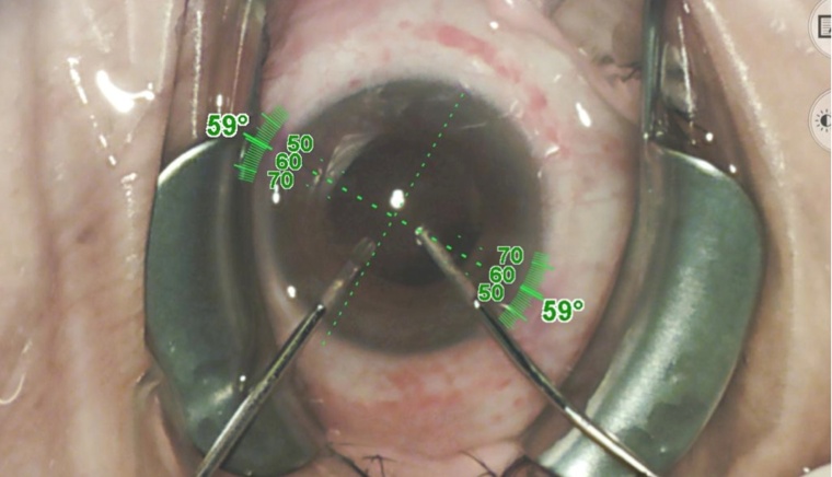 Intraoperative Achsmarkierung.