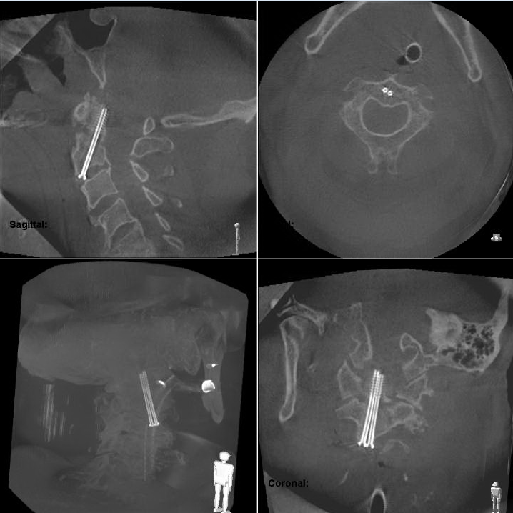 Rekonstruktion des intraoperativen 3D-Scans zeigt die korrekte...