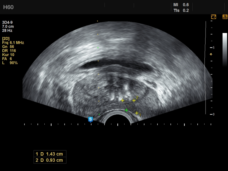 2D-Ultraschall der Prostata.