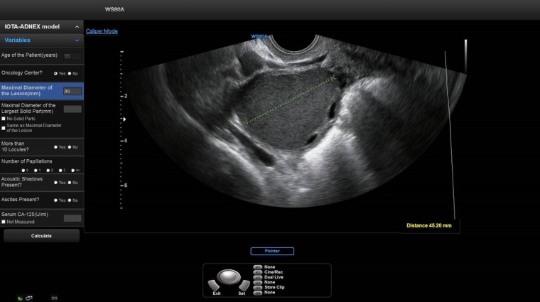Photo: Erleichterte Ovarialkarzinomvorsorge