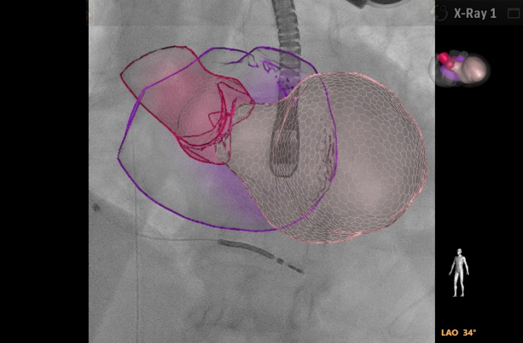 KI in der Kardiologie: Der Philips EchoNavigator fusioniert...