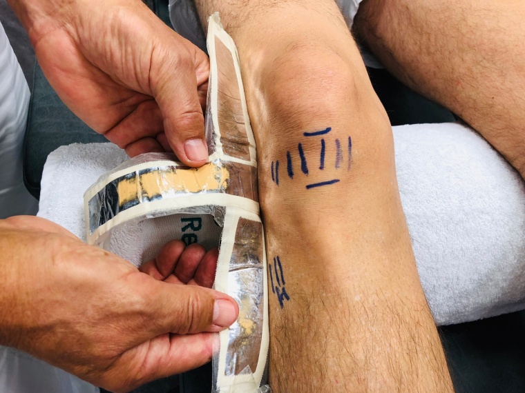 Abb. 1: Behandlungserfolg durch Sanotaping