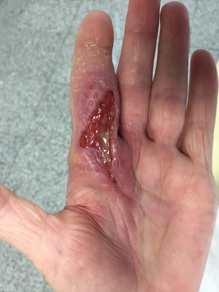 Abb. 2a: Offene Wunde einer 72 Jahre alten Patientin am Zeigefinger der linken...