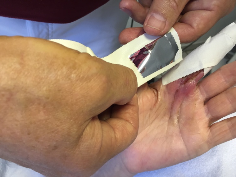 Abb. 2 b: Illustration der beginnenden Behandlung und das Prinzip von...