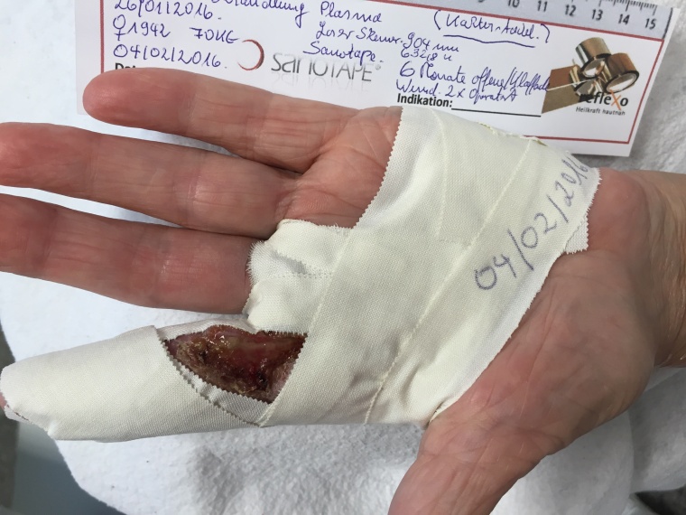 Abb. 2c: Illustration der beginnenden Behandlung und das Prinzip von Sanotaping....