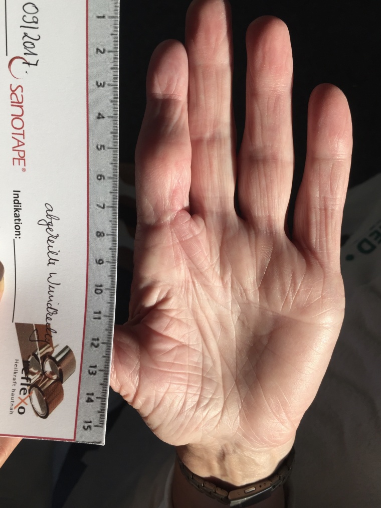 Abb. 2d: Ergenbis nach sieben Wochen Behandlungszeit: ein verheilter und...