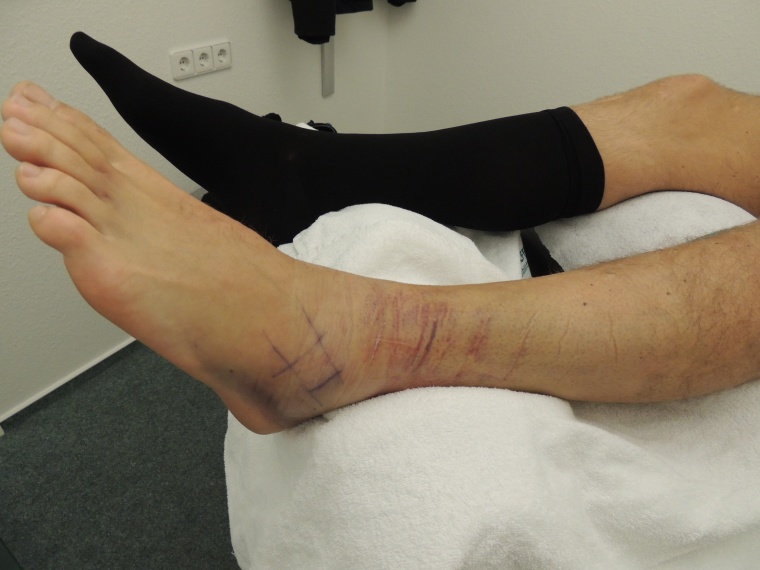 Abb. 3a: Schwellung und Hämatom am linken Knöchel des Patienten.