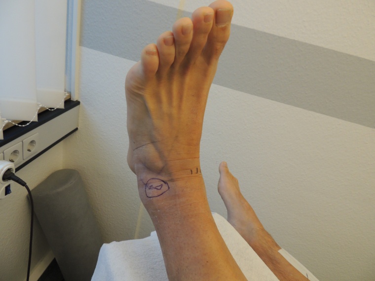 Abb. 3d: Das Sprunggelenk nach Abnahme des Tapeverbandes nach vier Tagen...