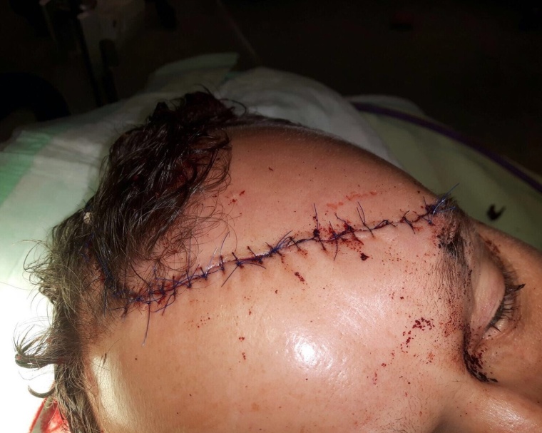 Abb. 4a: Ausgedehnte Naht einer Kopfwunde, die sich quer über den Kopf...